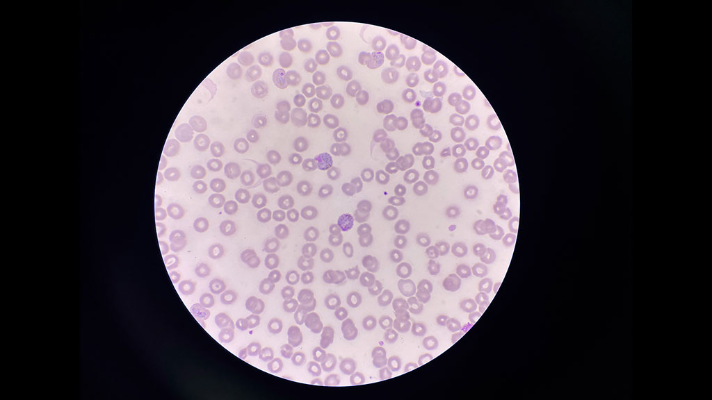 Malaria microscope slide