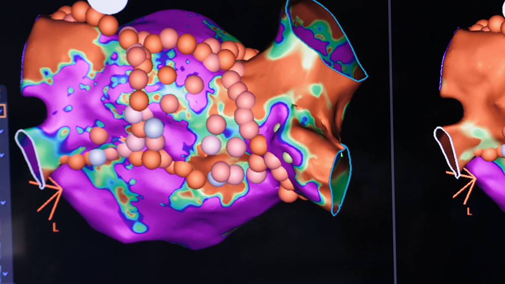 Image of heart after an ablation procedure